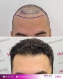 Before and after FUE hair transplant result at HairClinic Prive – restored hairline
