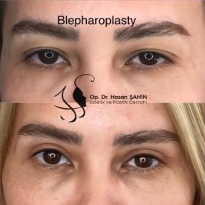 before-after photo tightening-of-facial-skin-facelift
