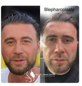 before-after photo tightening-of-facial-skin-facelift