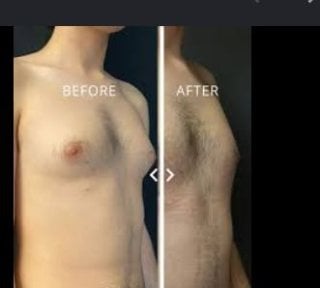before-after photo liposuction