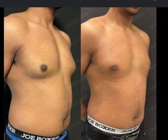 before-after photo liposuction