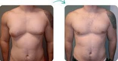 before-after photo liposuction