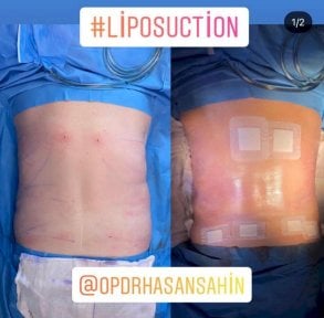 before-after photo liposuction