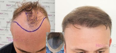 Before and after hair transplant results at HairClinic – restored hairline and fuller hair