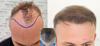 Before and after hair transplant results at HairClinic – restored hairline and fuller hair