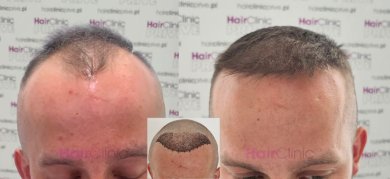 Before and after hair transplant results at HairClinic – restored hairline and fuller hair