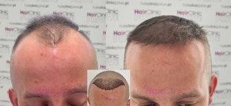 Before and after hair transplant results at HairClinic – restored hairline and fuller hair