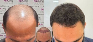 Before and after hair transplant results at HairClinic Prive – restored hairline and density