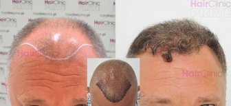 Before and after hair transplant results at HairClinic Prive – restored natural hairline