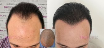 Before and after FUE hair transplant results at HairClinic Prive – restored hairline in male patient