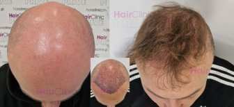 Before and after hair transplant results at HairClinic Prive – restored hairline and density
