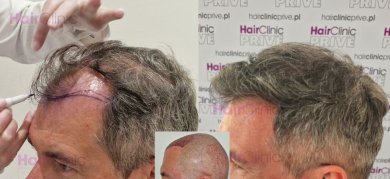 Before and after hair transplant results at HairClinic Prive – restored hairline and density
