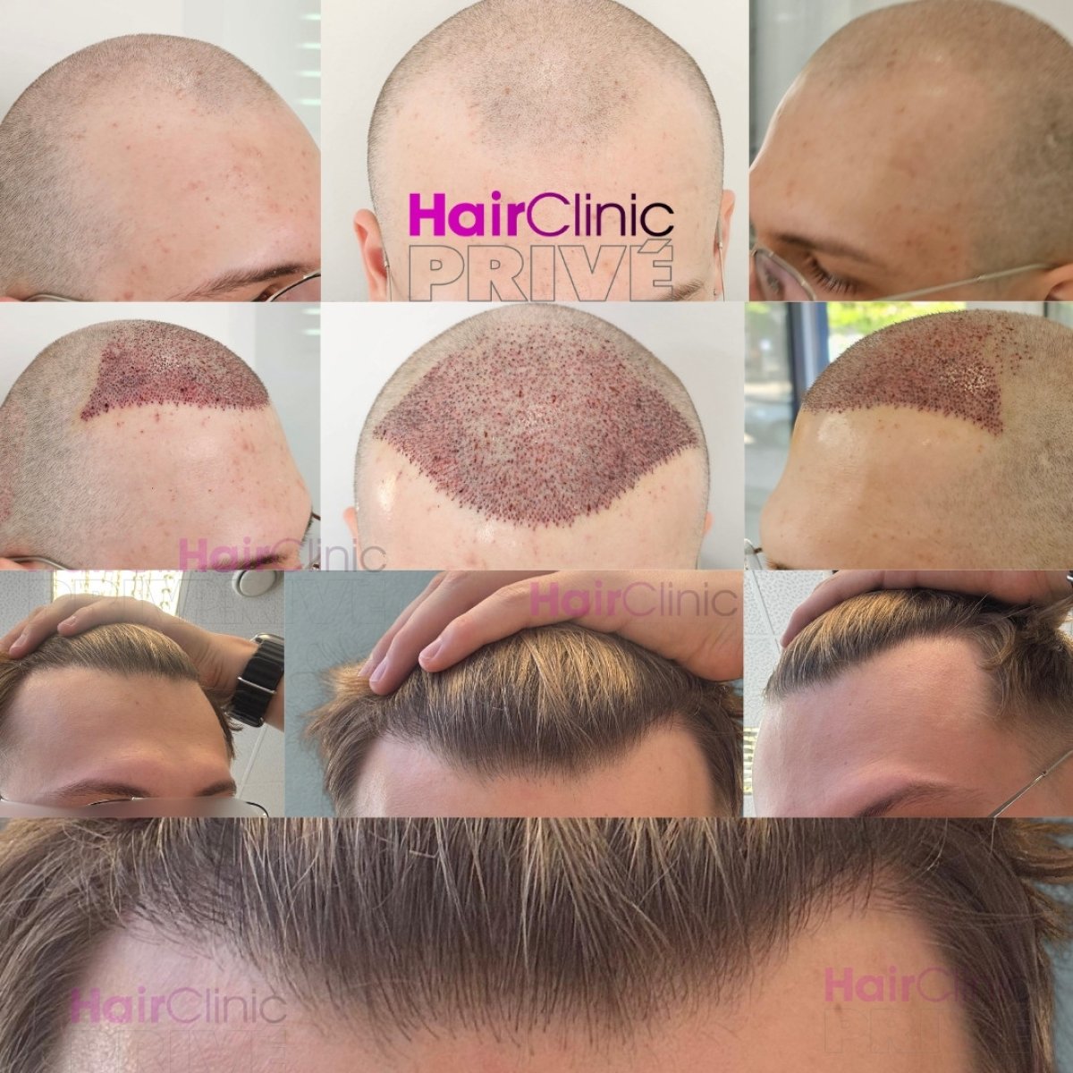 نتائج زراعة الشعر FUE قبل وبعد في Hair Clinic Privé – استعادة خط الشعر الطبيعي