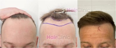 Before and after hair transplant result at Hair Clinic Privé – restored hairline in male patient