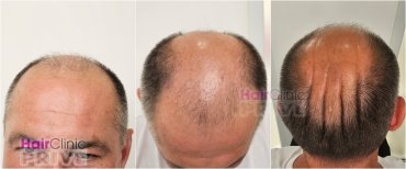 Before hair transplant at Hair Clinic Prive – visible male pattern baldness and thinning result