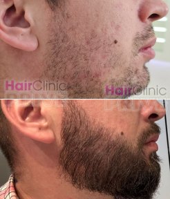 Before and after beard hair transplant results at Hair Clinic Prive – fuller facial hair