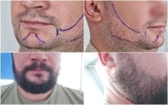 Before and after beard transplant results – fuller, natural beard restoration for men