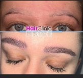 Before and after eyebrow transplant result at Hair Clinic Privé – fuller natural brows