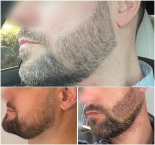 Before and after beard transplant results, fuller facial hair restoration for men