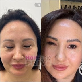 Before and after facial rejuvenation results at Hair Clinic Prive – smoother, youthful skin