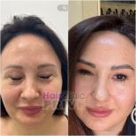 Before and after facial rejuvenation results at Hair Clinic Prive – smoother, youthful skin