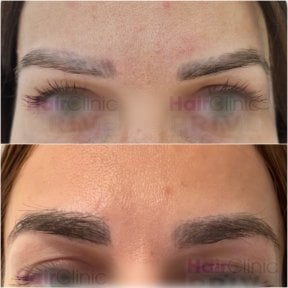 Before and after eyebrow transplant results at Hair Clinic Prive – fuller, natural brows