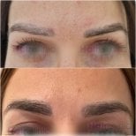 Before and after eyebrow transplant results at Hair Clinic Prive – fuller, natural brows