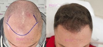 Before and after hair transplant results at HairClinic – restored hairline and fuller scalp