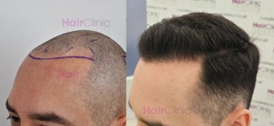 Before and after hair transplant result at HairClinic – restored natural hairline in male patient