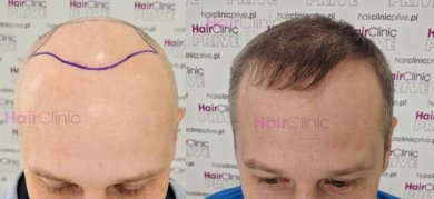 Before and after hair transplant results at HairClinic Prive – restored natural hairline