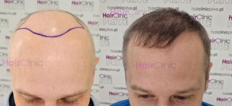 Before and after hair transplant results at HairClinic Prive – restored natural hairline