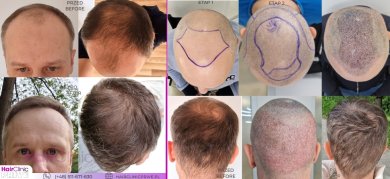Before and after hair transplant results at HairClinic Prive – restored hairline and density