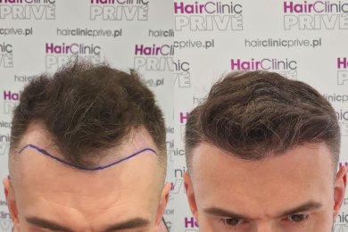 Before and after hair transplant results at HairClinic Prive – restored fuller hairline