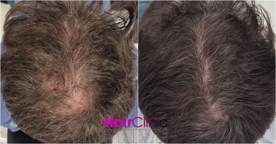 Before and after hair transplant result at HairClinic Prive – visible hair density improvement