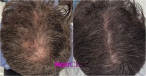 Before and after hair transplant result at HairClinic Prive – visible hair density improvement
