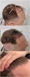 Before and after FUE hair transplant results at Hair Clinic Prive – restored hairline
