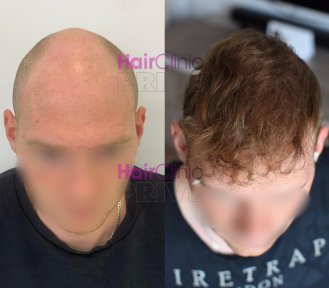Before and after hair transplant result at HairClinic Prive – restored hairline and density