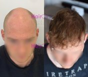 Before and after hair transplant result at HairClinic Prive – restored hairline and density