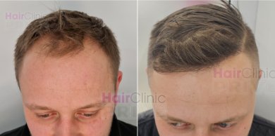 Before and after hair transplant results at Hair Clinic Prive – restored hairline in male patient