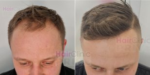 Before and after hair transplant results at Hair Clinic Prive – restored hairline in male patient