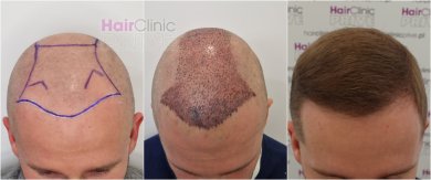 Before and after hair transplant at HairClinic Prive – restored hairline and fuller hair result