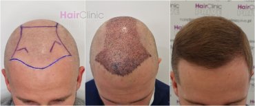 Before and after hair transplant at HairClinic Prive – restored hairline and fuller hair result