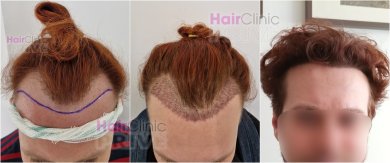 Before and after hair transplant results at Hair Clinic Prive – restored hairline and density