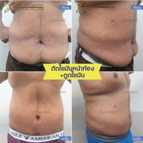 before-after photo penis-enlargement