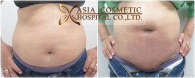 before-after photo penis-enlargement
