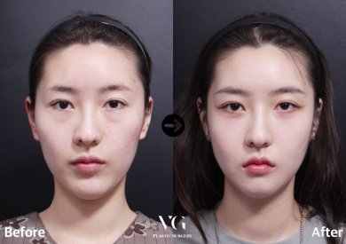 Résultats avant/après blépharoplastie inférieure chez VG Plastic Surgery, regard rafraîchi