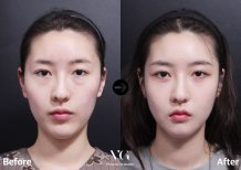 Résultats avant/après blépharoplastie inférieure chez VG Plastic Surgery, regard rafraîchi