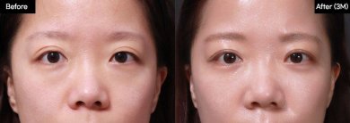 Résultats avant/après blépharoplastie inférieure chez VG Plastic Surgery, poches réduites