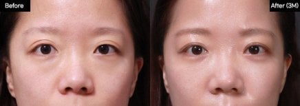 Résultats avant/après blépharoplastie inférieure chez VG Plastic Surgery, poches réduites