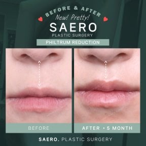 Before and after philtrum reduction results at SAERO Plastic Surgery, improved lip contour